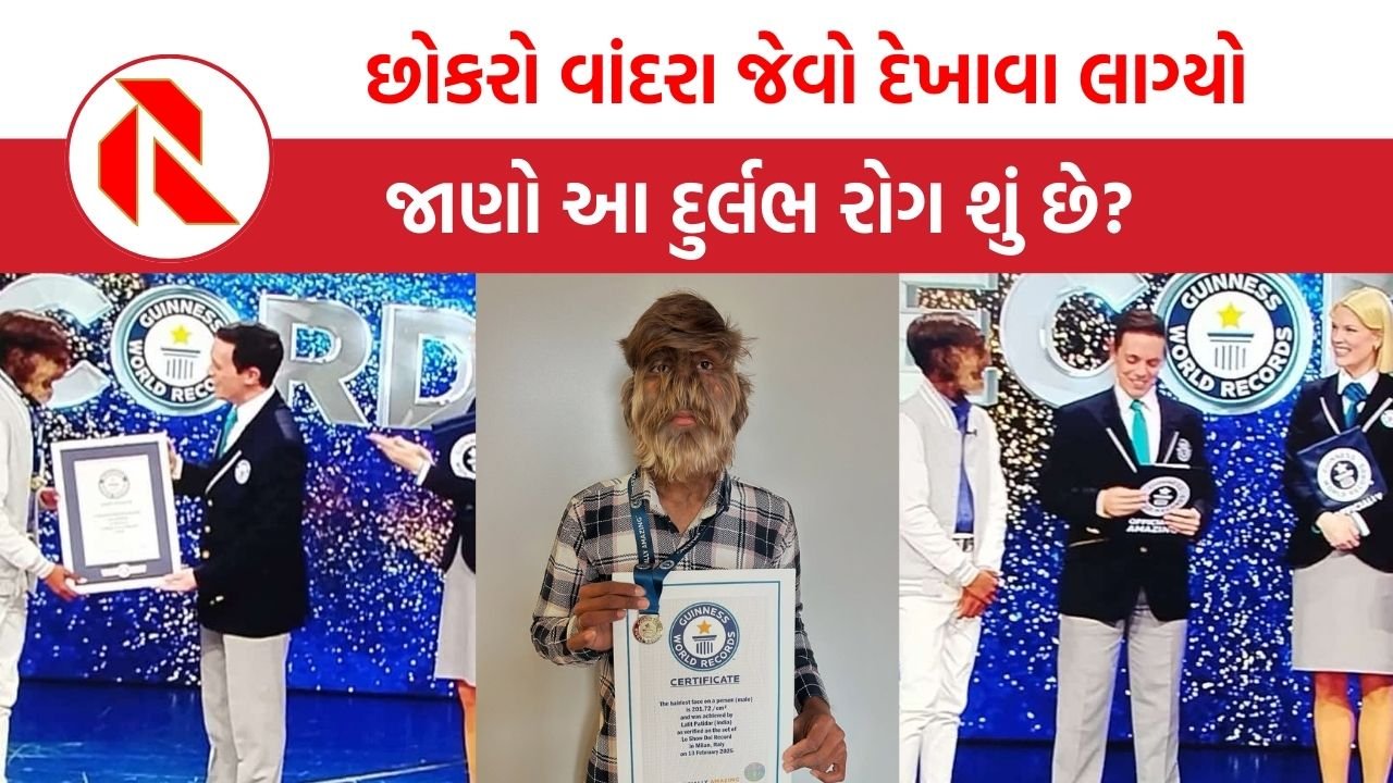 MP News: છોકરાનો આખો ચહેરો વાળથી ઢંકાઈ ગયો, જાણો આ દુર્લભ રોગ શું છે અને શા માટે થાય છે?