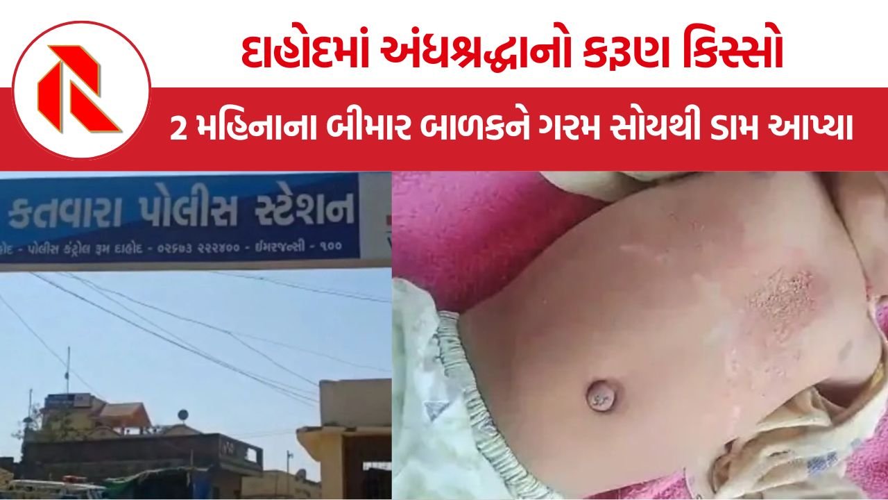 Dahod superstition child abuse: દાહોદમાં અંધશ્રદ્ધાનો કરૂણ કિસ્સો, 2 મહિનાના બીમાર બાળકને ગરમ સોયથી ડામ આપનાર ભૂવાની ધરપકડ